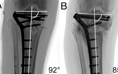 Fracture pattern and fixation type related to loss of reduction in bicondylar tibial plateau fractures