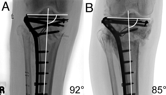 Fracture pattern and fixation type related to loss of reduction in bicondylar tibial plateau fractures