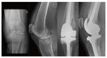 Radiographic Predictors of Conversion to Total Knee Arthroplasty After Tibial Plateau Fracture Surgery: Results in a Large Multicenter Cohort