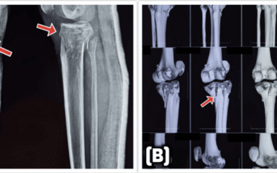Open tibial plateau fractures: Infection rate and functional outcomes