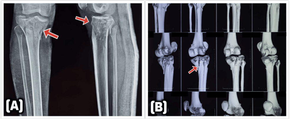 Open tibial plateau fractures: Infection rate and functional outcomes