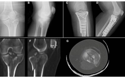 Predictors of reduction loss in tibial plateau fracture surgery: Focusing on posterior coronal fractures