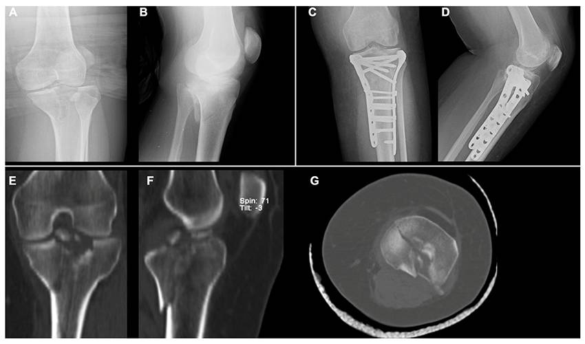 Predictors of reduction loss in tibial plateau fracture surgery: Focusing on posterior coronal fractures