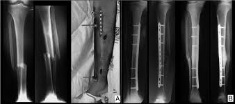 Influence of the fixation stability on the healing time–a numerical study of a patient-specific fracture healing process