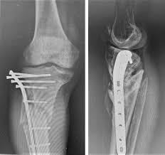 Failure of fixation of tibial plateau fractures