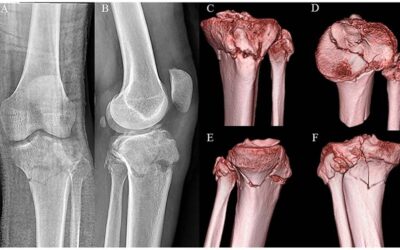 Complications and timing of soft tissue coverage after complete articular, open tibial plateau fractures