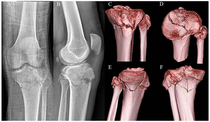 Complications and timing of soft tissue coverage after complete articular, open tibial plateau fractures