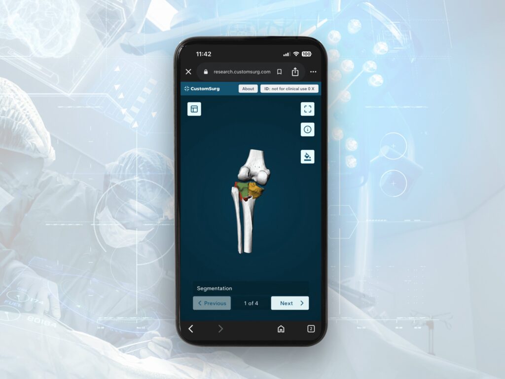 OrthoPlanner™ 3D surgical plan shown on a smartphone